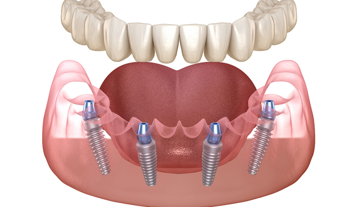 Types of Bone Grafts Used For Dental Implants